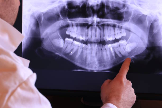 Best Emergency Tooth Extraction in Grantsburg, WI