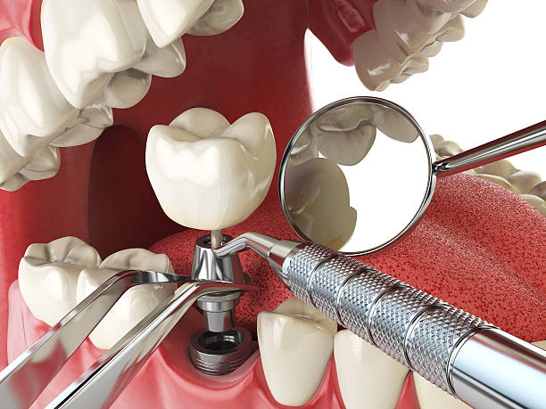 Best Emergency Dental Care for Broken or Chipped Teeth in Grantsburg, WI